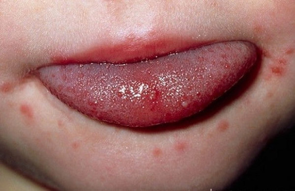 Triệu chứng tay chân miệng điển hình là loét ở lưỡi kèm theo phỏng nước